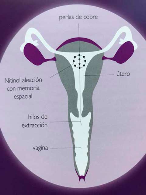 DIU, Dispositivo Intrauterino. Lucía Vior Ginecóloga