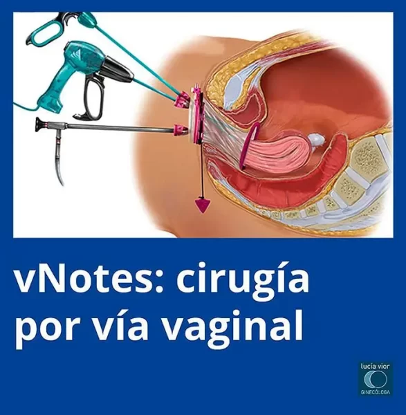 vNOTES, imagen de referencia, cirugía ginecológica